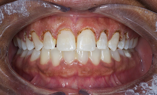 During gum recontouring with laser gum treatment.
