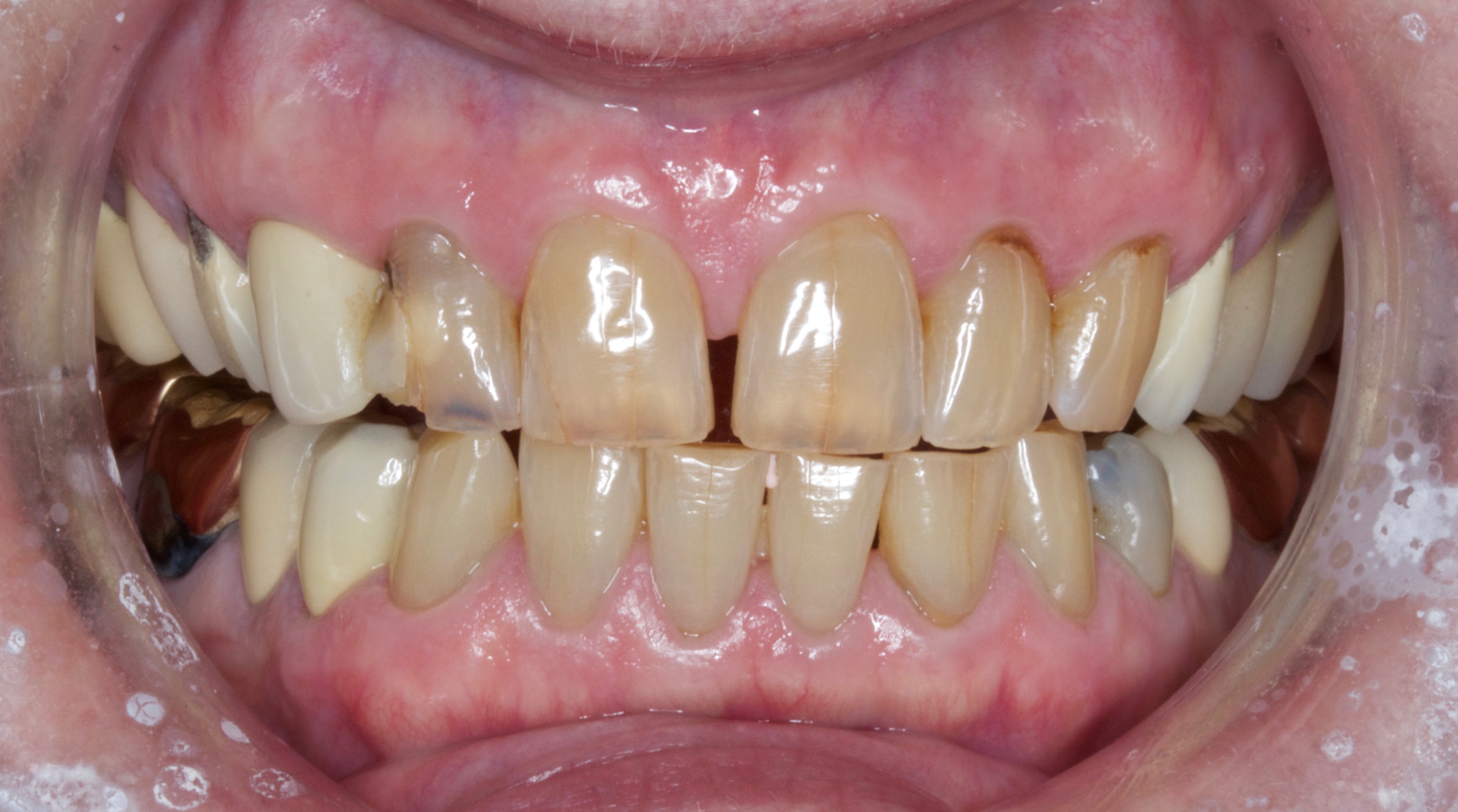Before Anti Aging Dentistry