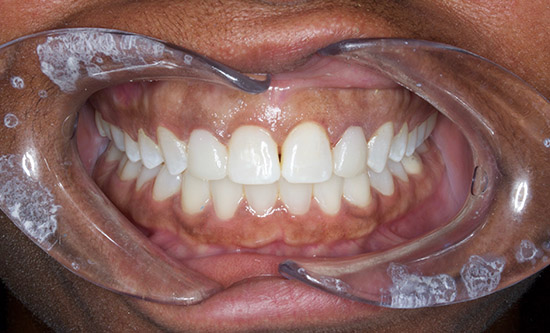 After laser gum treatment.