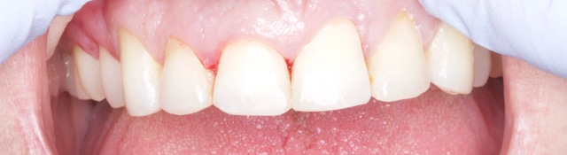 gum surgery raleigh gum surgery raleigh