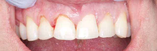 raleigh dentist gum recontour raleigh dentist gum recontour