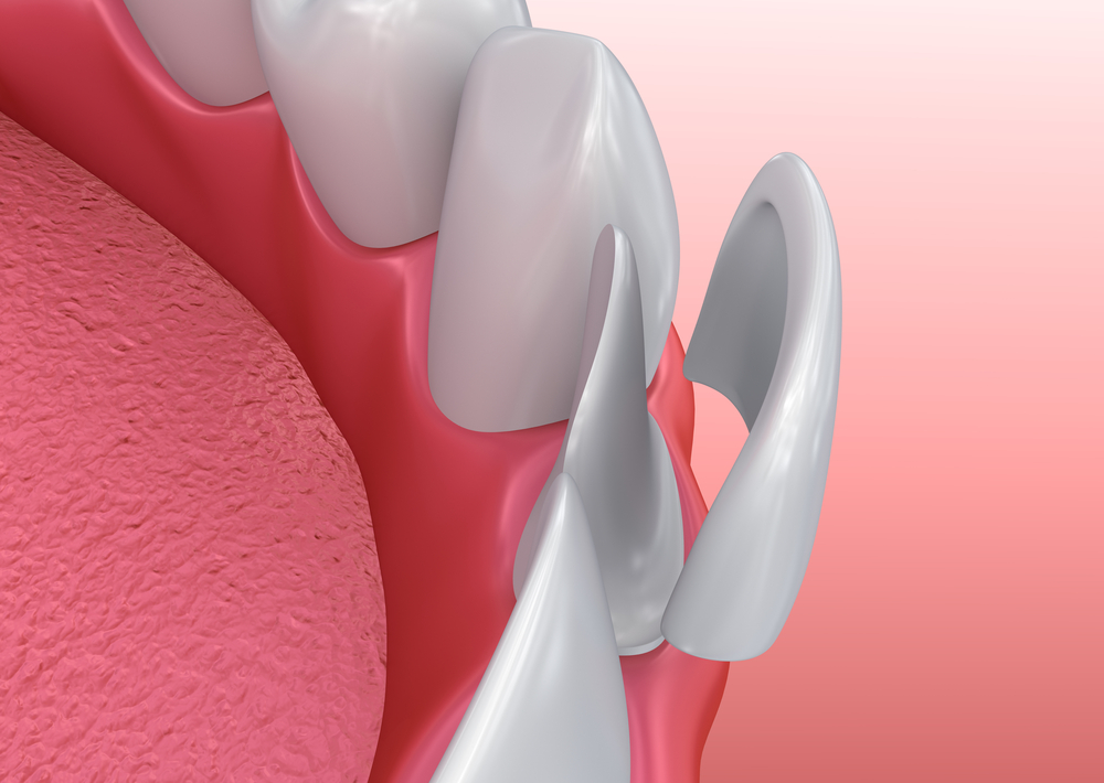 porcelain veneers Raleigh
