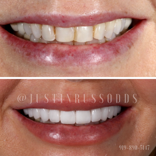 Before and after a patient gets porcelain veneers.