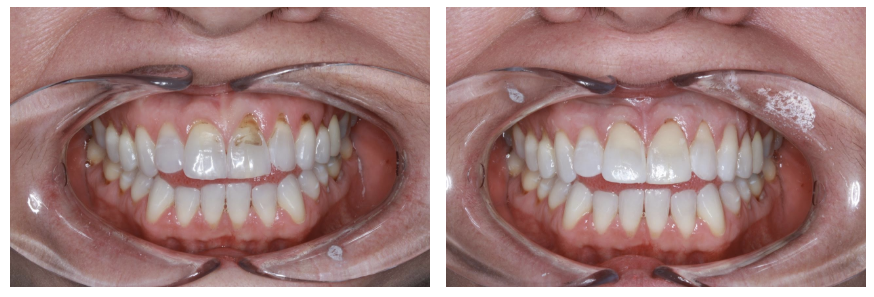 Dental bonding Raleigh