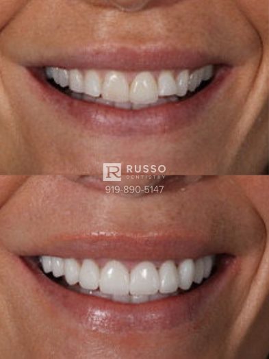 Smile Cases Russo DDS Before After White Teeth Veneers Implants Before After Cosmetic Dentistry