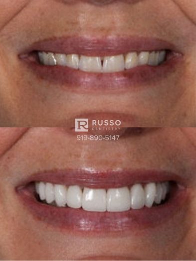 Smile Cases Russo DDS Before After White Teeth Veneers Implants Before After Cosmetic Dentistry