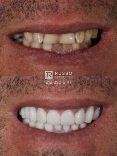 Smile Cases Russo DDS Before After White Teeth Veneers Implants Before After Cosmetic Dentistry