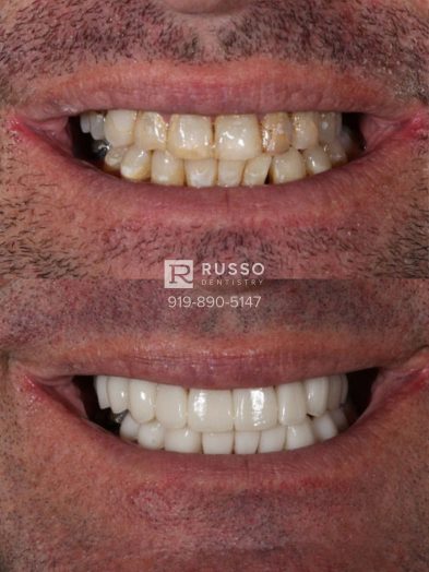Smile Cases Russo DDS Before After White Teeth Veneers Implants Before After Cosmetic Dentistry