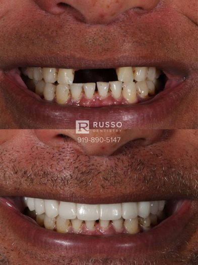 Smile Cases Russo DDS Before After White Teeth Veneers Implants Before After Cosmetic Dentistry