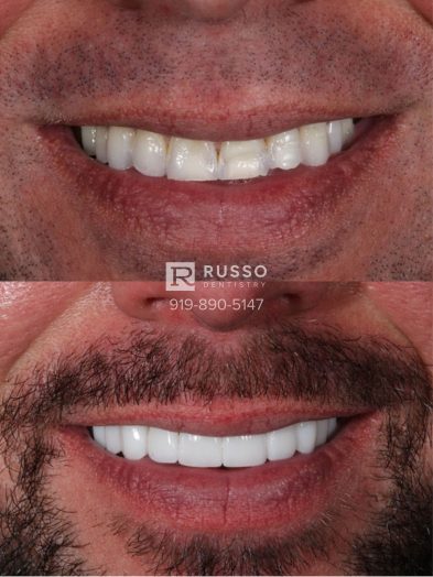 Smile Cases Russo DDS Before After White Teeth Veneers Implants Before After Cosmetic Dentistry