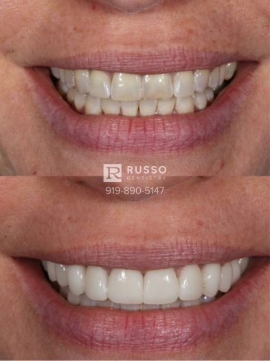 Smile Cases Russo DDS Before After White Teeth Veneers Implants Before After Cosmetic Dentistry
