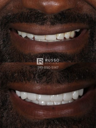 Smile Cases Russo DDS Before After White Teeth Veneers Implants Before After Cosmetic Dentistry