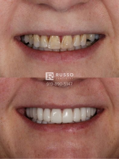 Smile Cases Russo DDS Before After White Teeth Veneers Implants Before After Cosmetic Dentistry