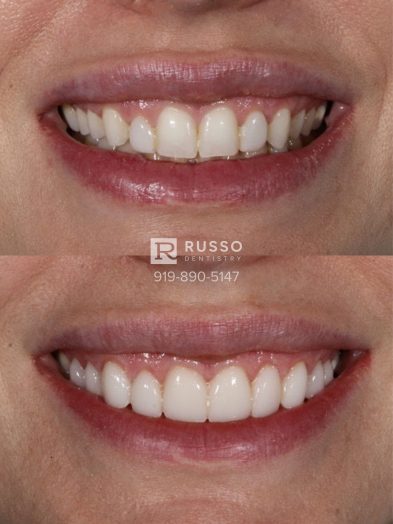 Smile Cases Russo DDS Before After White Teeth Veneers Implants Before After Cosmetic Dentistry