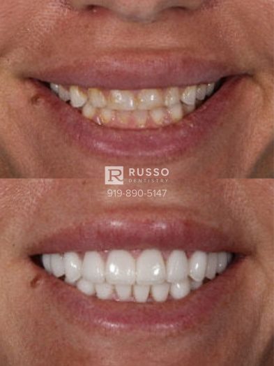 Smile Cases Russo DDS Before After White Teeth Veneers Implants Before After Cosmetic Dentistry