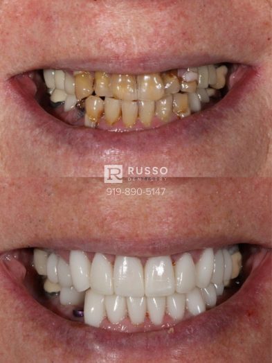 Smile Cases Russo DDS Before After White Teeth Veneers Implants Before After Cosmetic Dentistry
