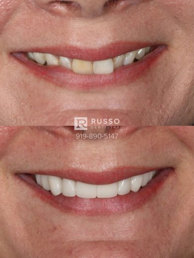Smile Cases Russo DDS Before After White Teeth Veneers Implants Before After Cosmetic Dentistry