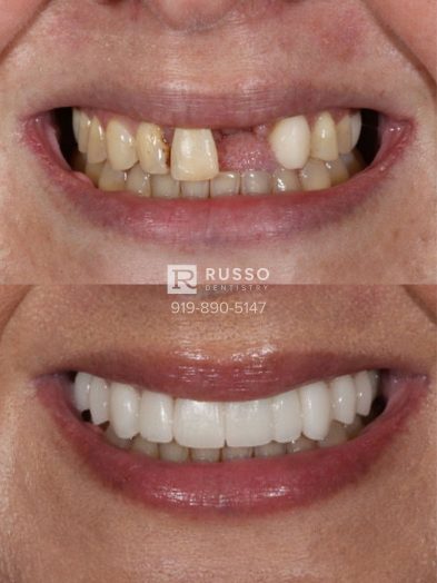 Smile Cases Russo DDS Before After White Teeth Veneers Implants Before After Cosmetic Dentistry