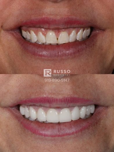 Smile Cases Russo DDS Before After White Teeth Veneers Implants Before After Cosmetic Dentistry
