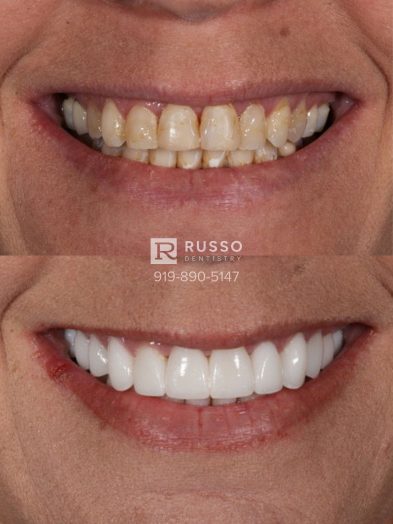 Smile Cases Russo DDS Before After White Teeth Veneers Implants Before After Cosmetic Dentistry