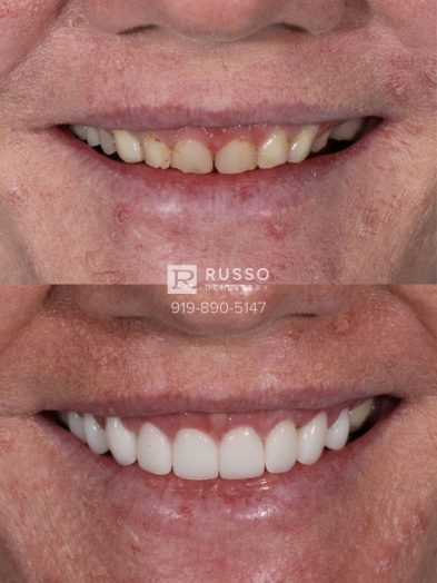 Smile Cases Russo DDS Before After White Teeth Veneers Implants Before After Cosmetic Dentistry