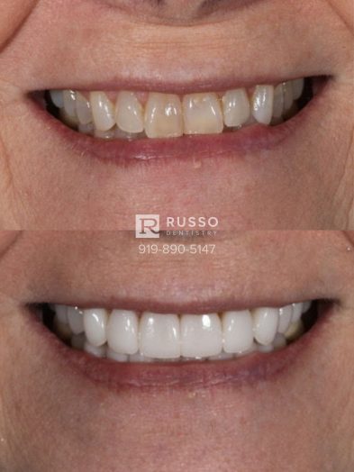 Smile Cases Russo DDS Before After White Teeth Veneers Implants Before After Cosmetic Dentistry