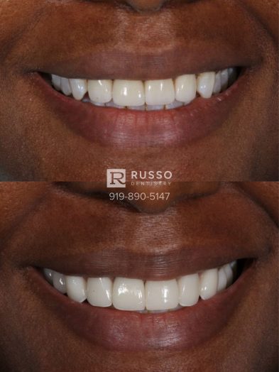 Smile Cases Russo DDS Before After White Teeth Veneers Implants Before After Cosmetic Dentistry