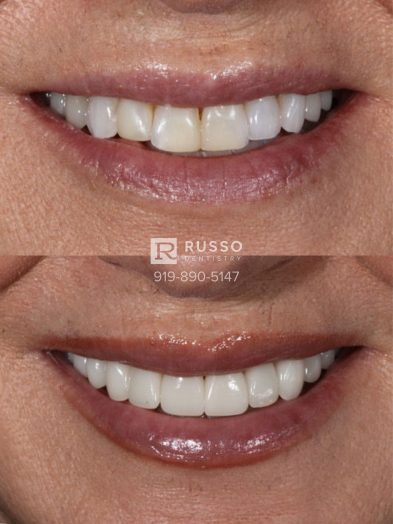 Smile Cases Russo DDS Before After White Teeth Veneers Implants Before After Cosmetic Dentistry