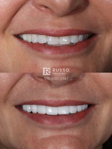 Smile Cases Russo DDS Before After White Teeth Veneers Implants Before After Cosmetic Dentistry