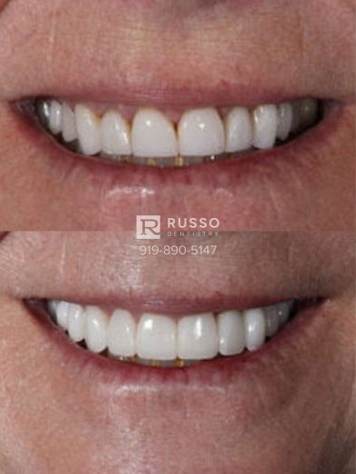 Smile Cases Russo DDS Before After White Teeth Veneers Implants Before After Cosmetic Dentistry