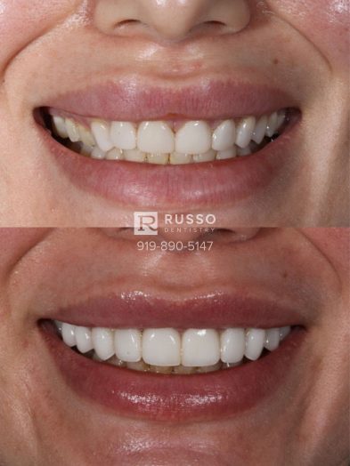 Smile Cases Russo DDS Before After White Teeth Veneers Implants Before After Cosmetic Dentistry