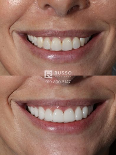 Smile Cases Russo DDS Before After White Teeth Veneers Implants Before After Cosmetic Dentistry