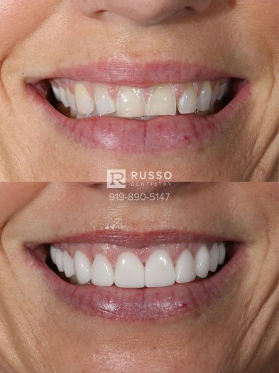 Smile Cases Russo DDS Before After White Teeth Veneers Implants Before After Cosmetic Dentistry