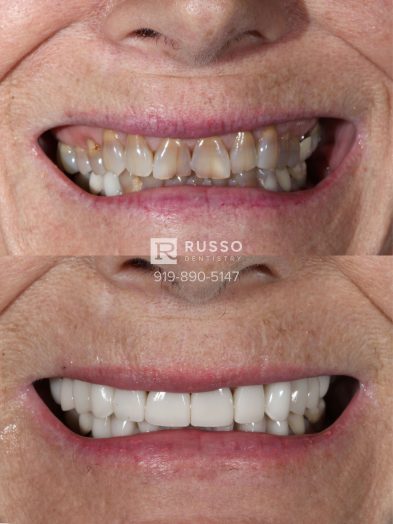 Smile Cases Russo DDS Before After White Teeth Veneers Implants Before After Cosmetic Dentistry Top Bottom Row