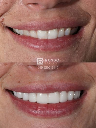 Smile Cases Russo DDS Before After White Teeth Veneers Implants Before After Cosmetic Dentistry