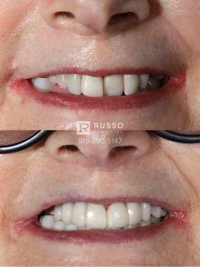 Smile Cases Russo DDS Before After White Teeth Veneers Implants Before After Cosmetic Dentistry