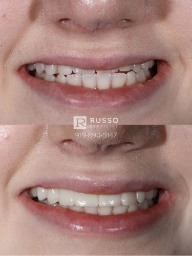 Smile Cases Russo DDS Before After White Teeth Veneers Implants Before After Cosmetic Dentistry