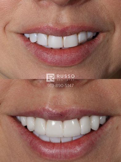 Smile Cases Russo DDS Before After White Teeth Veneers Implants Before After Cosmetic Dentistry