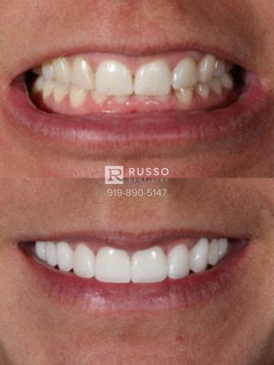 Smile Cases Russo DDS Before After White Teeth Veneers Implants Before After Cosmetic Dentistry