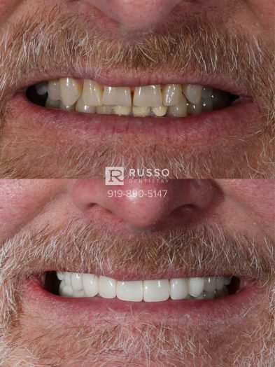 Smile Cases Russo DDS Before After White Teeth Veneers Implants Before After Cosmetic Dentistry