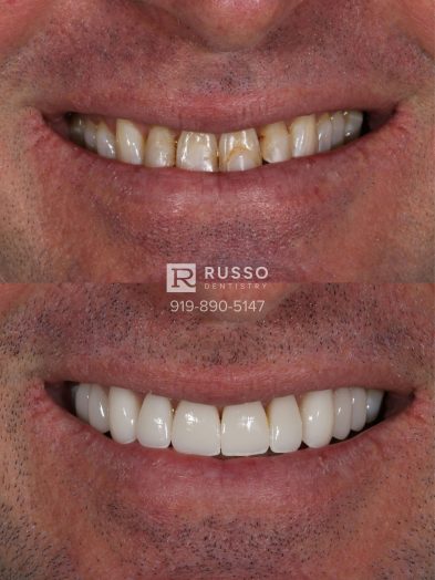 Smile Cases Russo DDS Before After White Teeth Veneers Implants Before After Cosmetic Dentistry