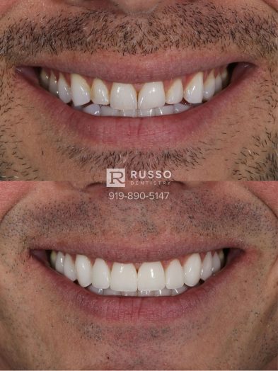 Smile Cases Russo DDS Before After White Teeth Veneers Implants Before After Cosmetic Dentistry