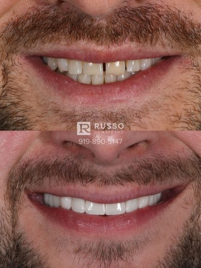 Smile Cases Russo DDS Before After White Teeth Veneers Implants Before After Cosmetic Dentistry