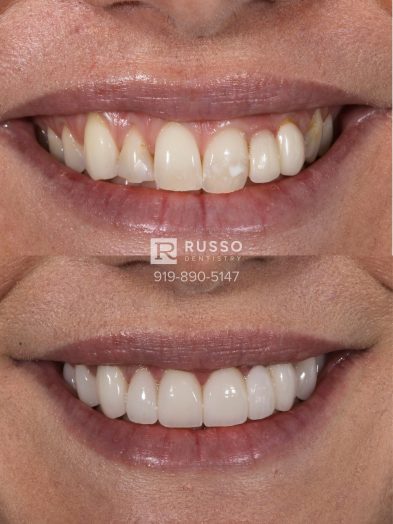 Smile Cases Russo DDS Before After White Teeth Veneers Implants Before After Cosmetic Dentistry