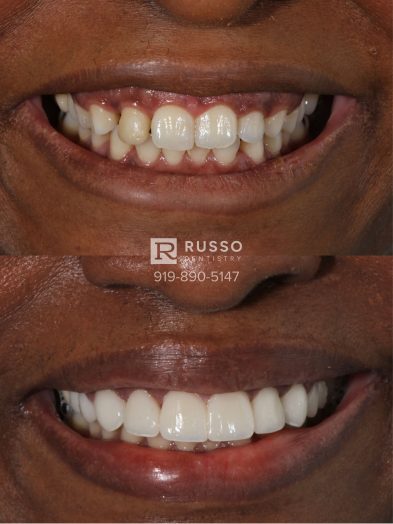 Smile Cases Russo DDS Before After White Teeth Veneers Implants Before After Cosmetic Dentistry