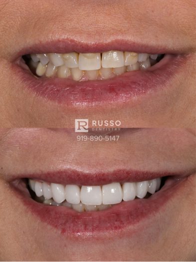 Smile Cases Russo DDS Before After White Teeth Veneers Implants Before After Cosmetic Dentistry