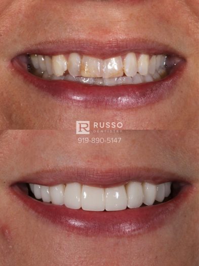 Smile Cases Russo DDS Before After White Teeth Veneers Implants Before After Cosmetic Dentistry