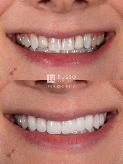 Smile Cases Russo DDS Before After White Teeth Veneers Implants Before After Cosmetic Dentistry