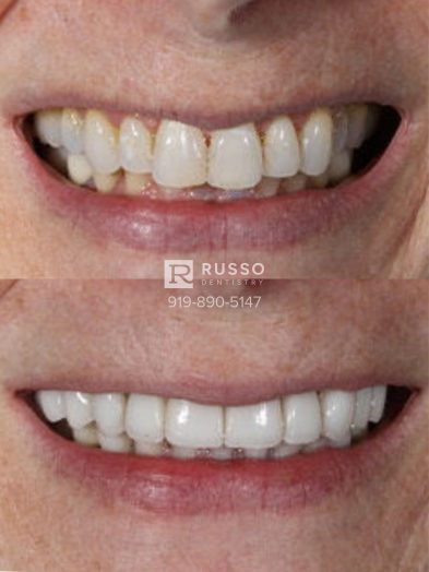 Smile Cases Russo DDS Before After White Teeth Veneers Implants Before After Cosmetic Dentistry