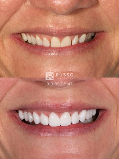 Smile Cases Russo DDS Before After White Teeth Veneers Implants Before After Cosmetic Dentistry